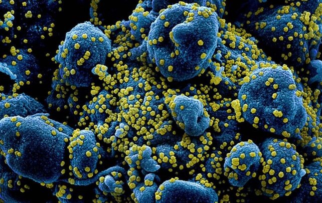 Partículas del virus SARS-COV-2 (en amarillo) infectando células (azuladas) aisladas de un paciente y vistas a través del microscopio electrónico de barrido con corrección de color. NIAID